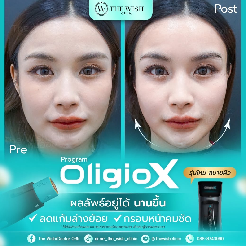 oligo x