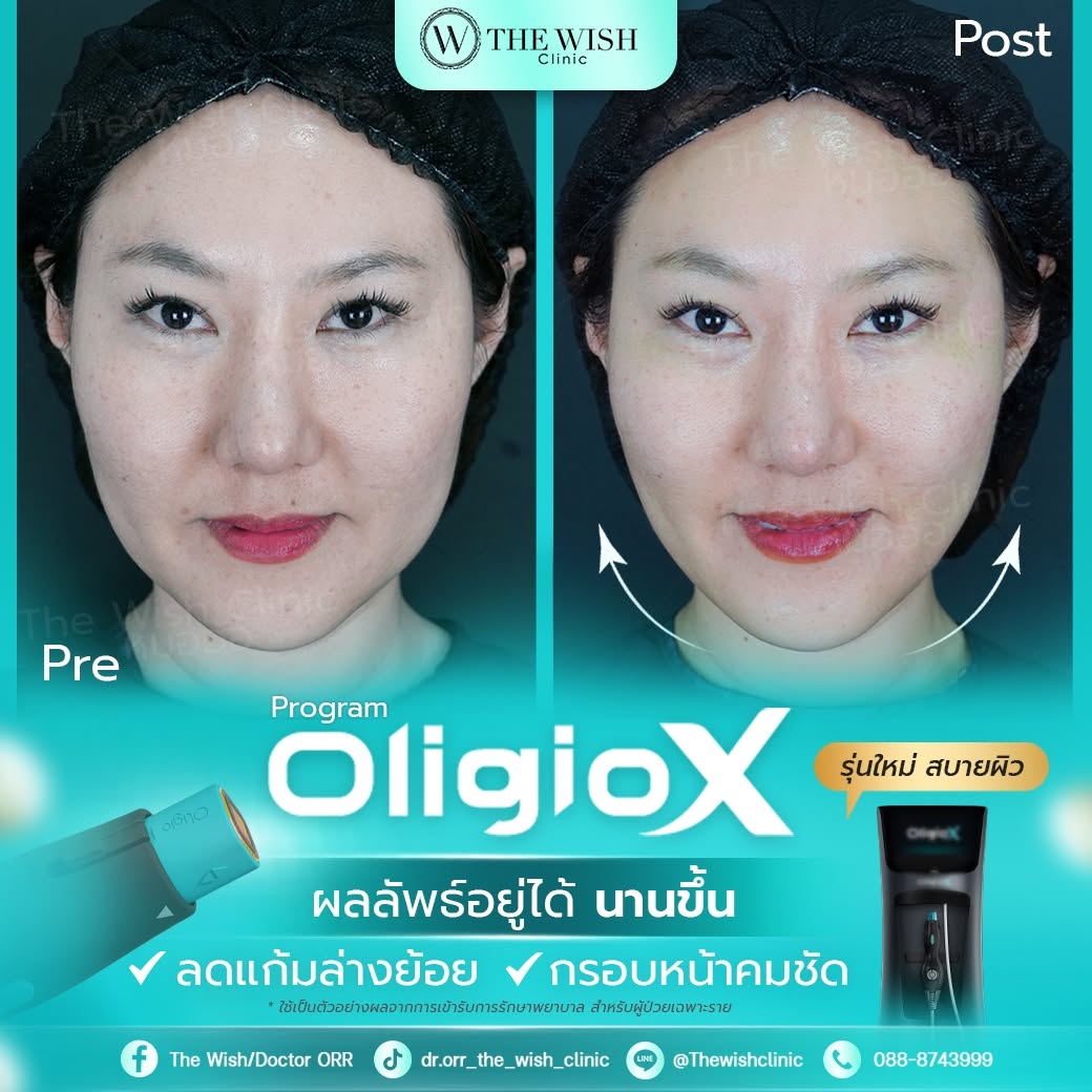 oligo x