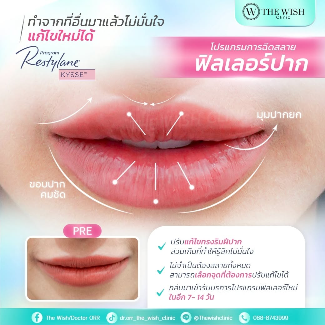 restylane kysse