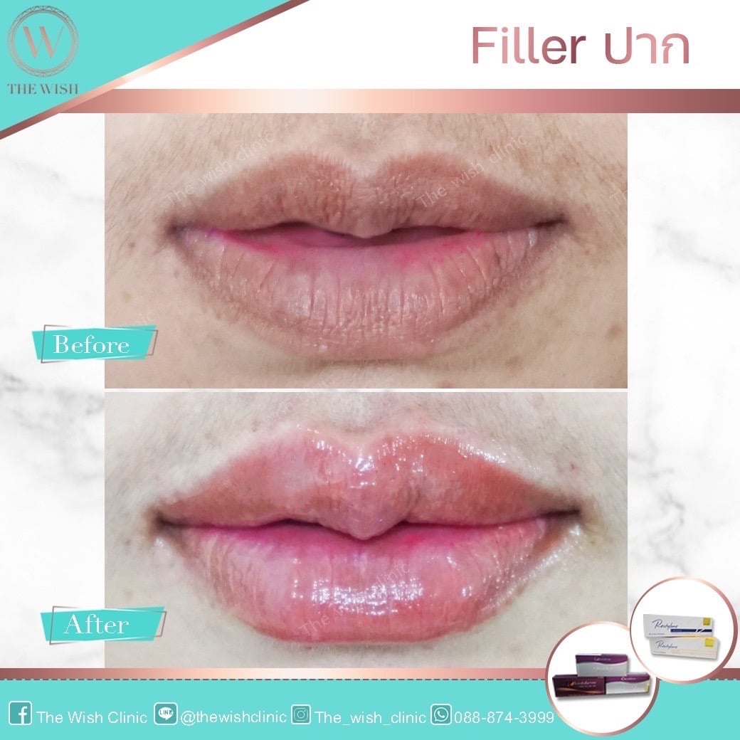 filler11feb22