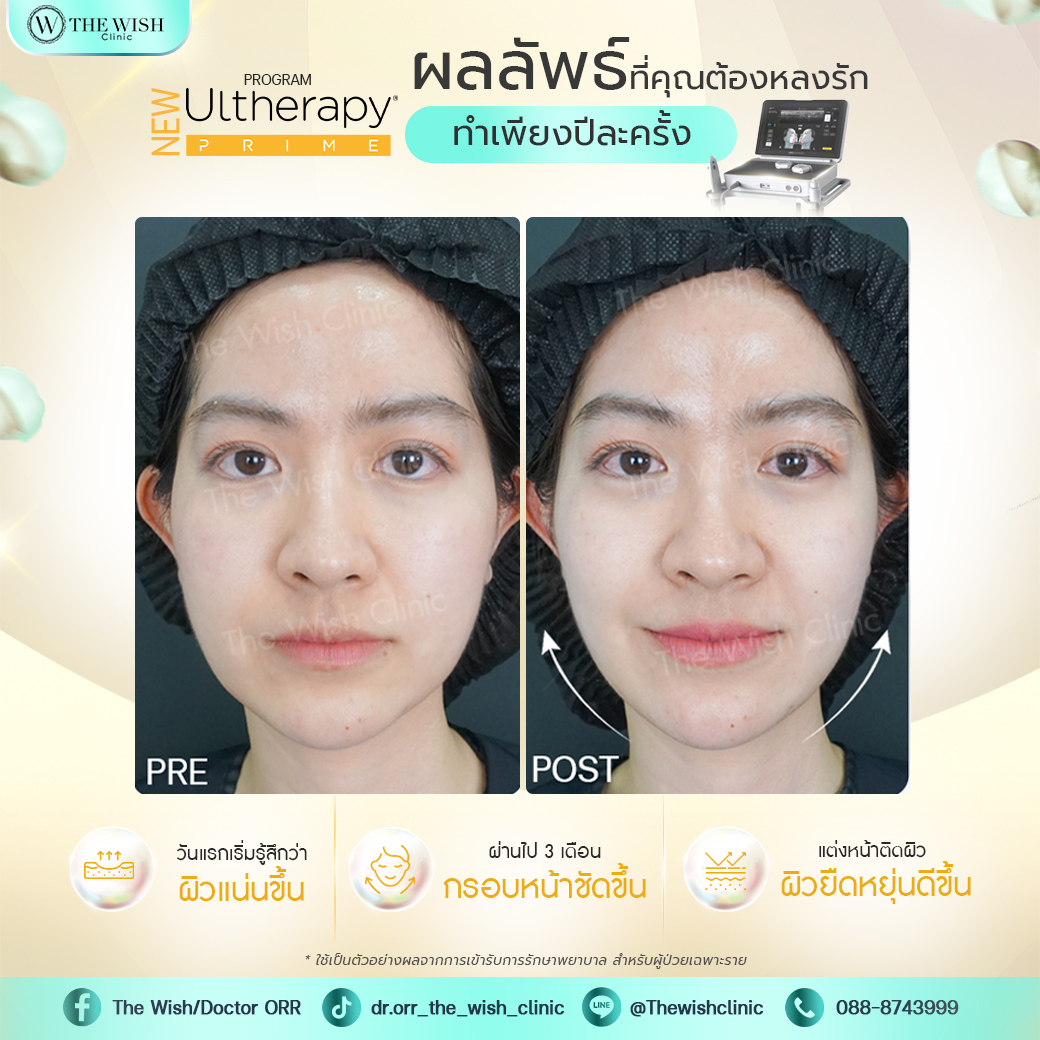 ultherapy prime