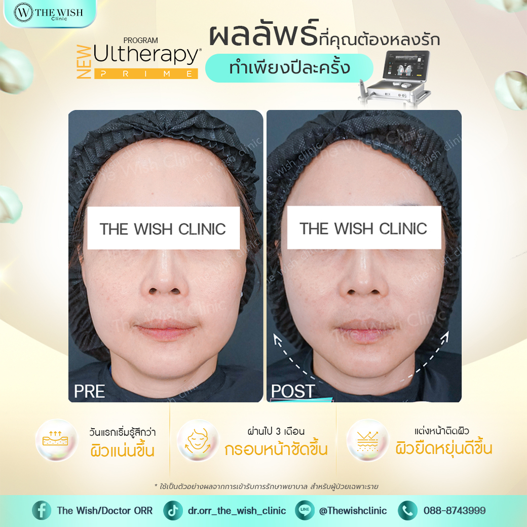 ultherapy prime