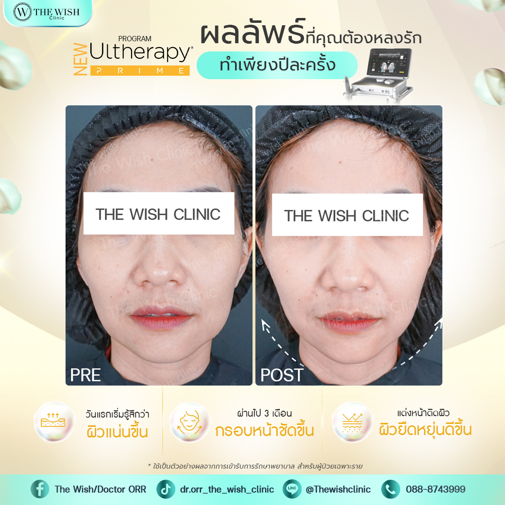 ultherapy prime