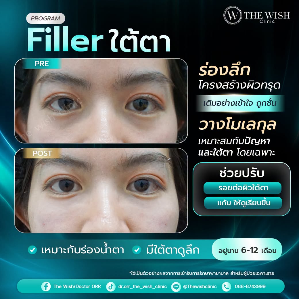 filler