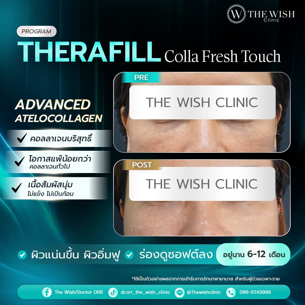 therafill
