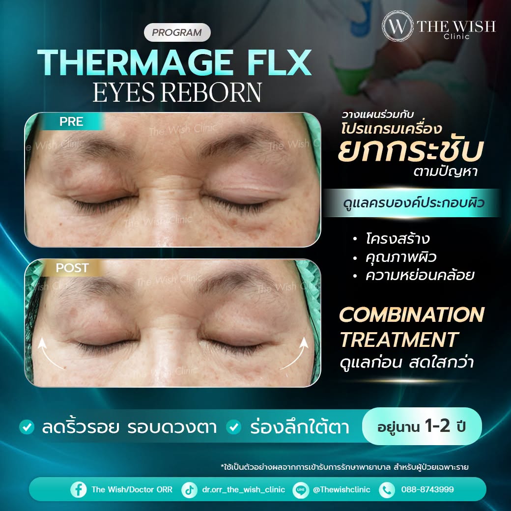thermage flx