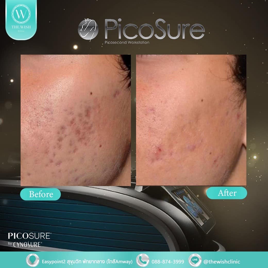 picosure