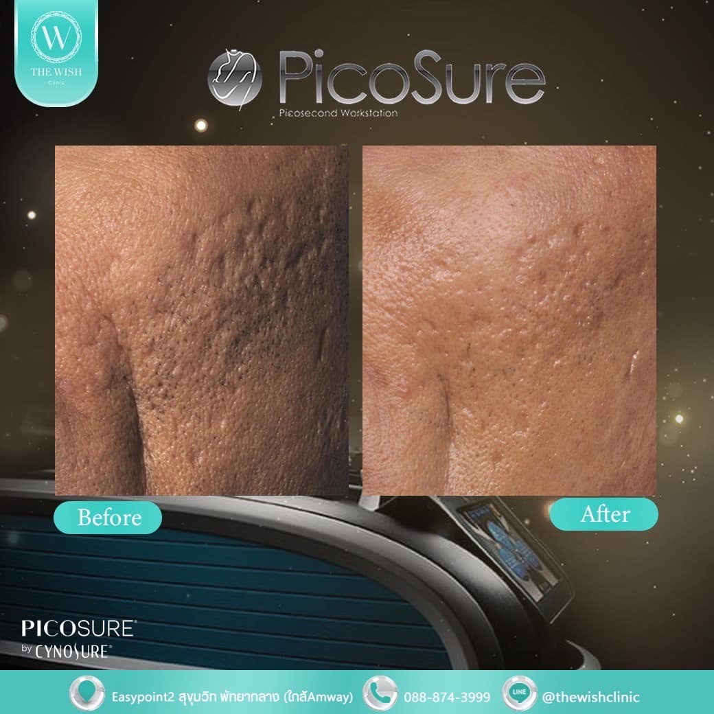 picosure