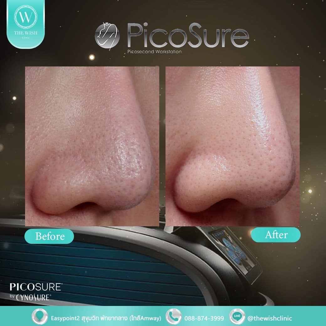 picosure