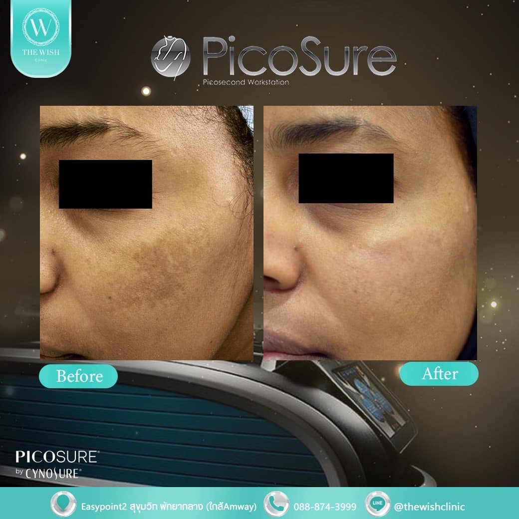 picosure