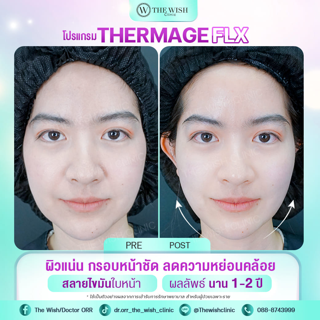 thermage