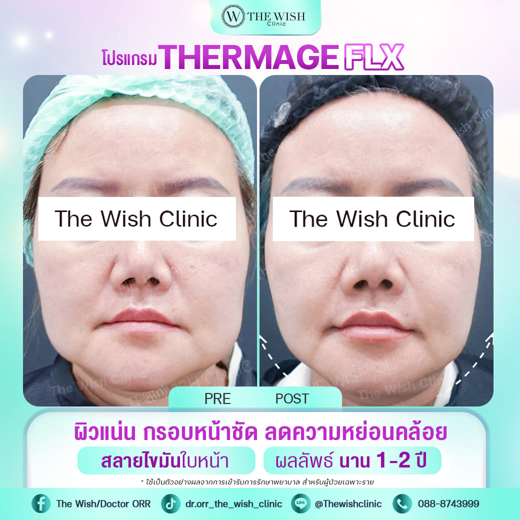 thermage