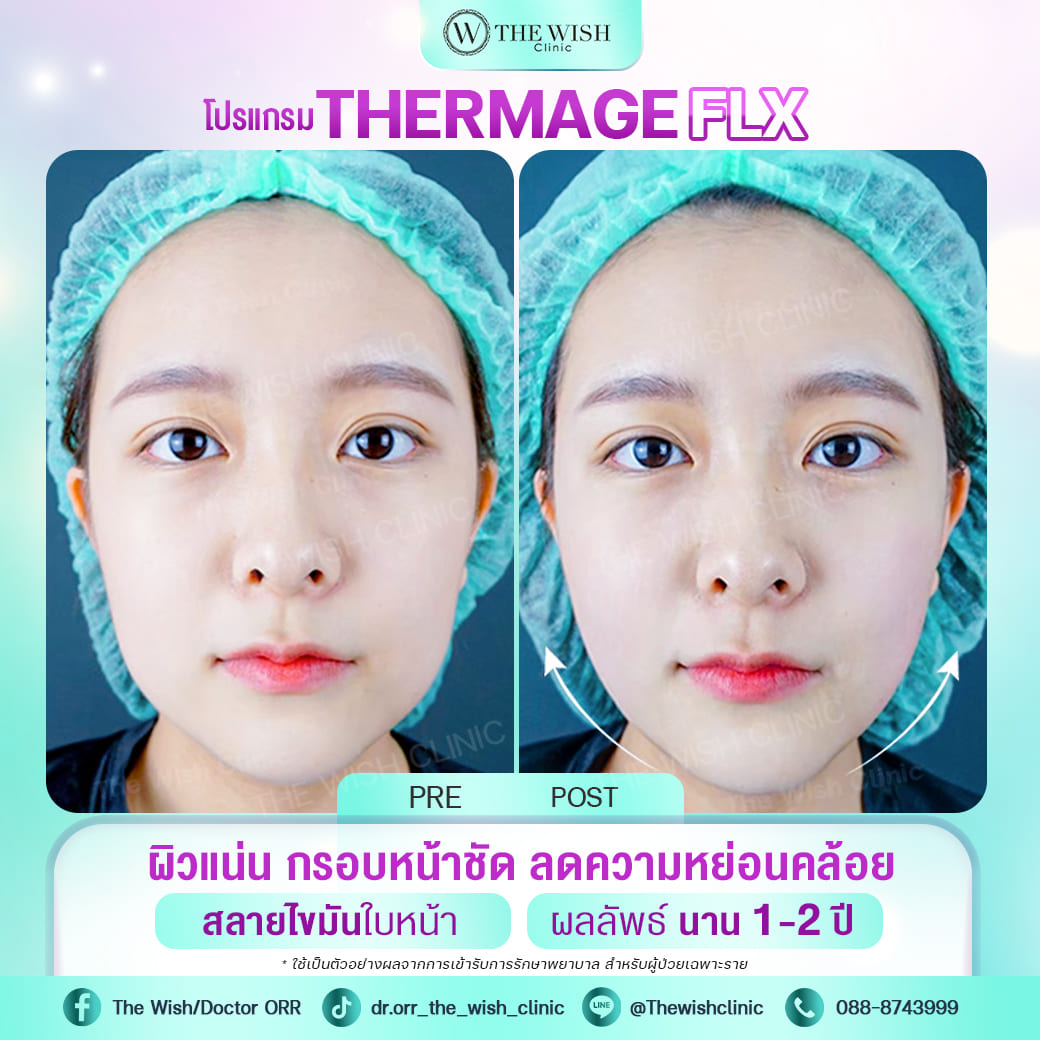 thermage