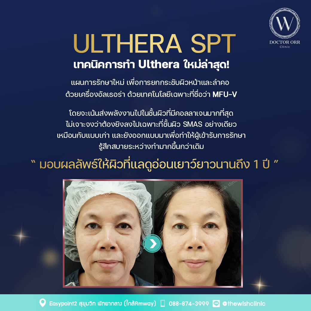 ultherapy