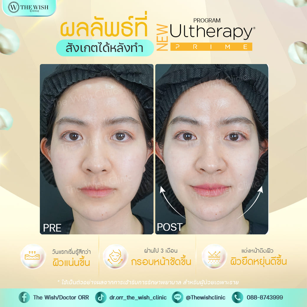 ultherapy prime