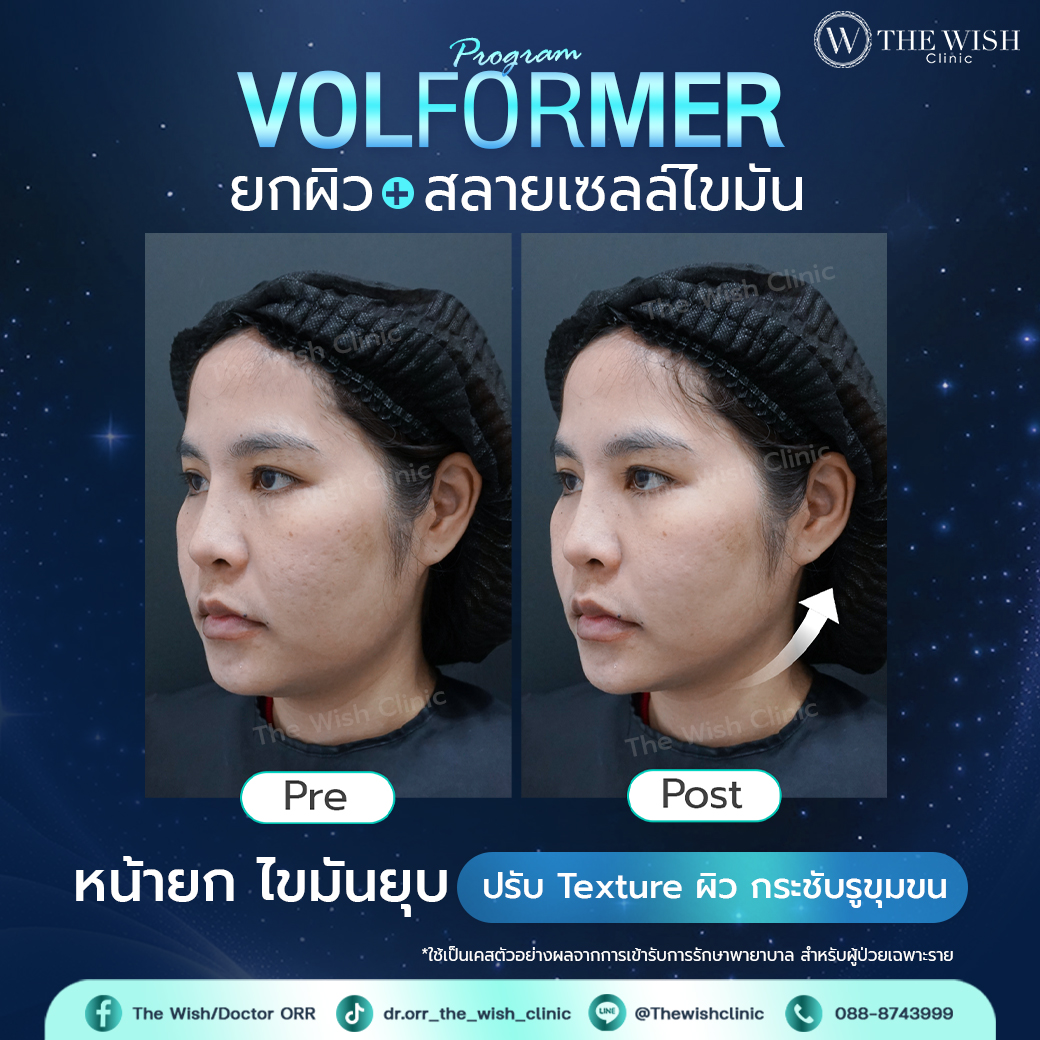 volformer