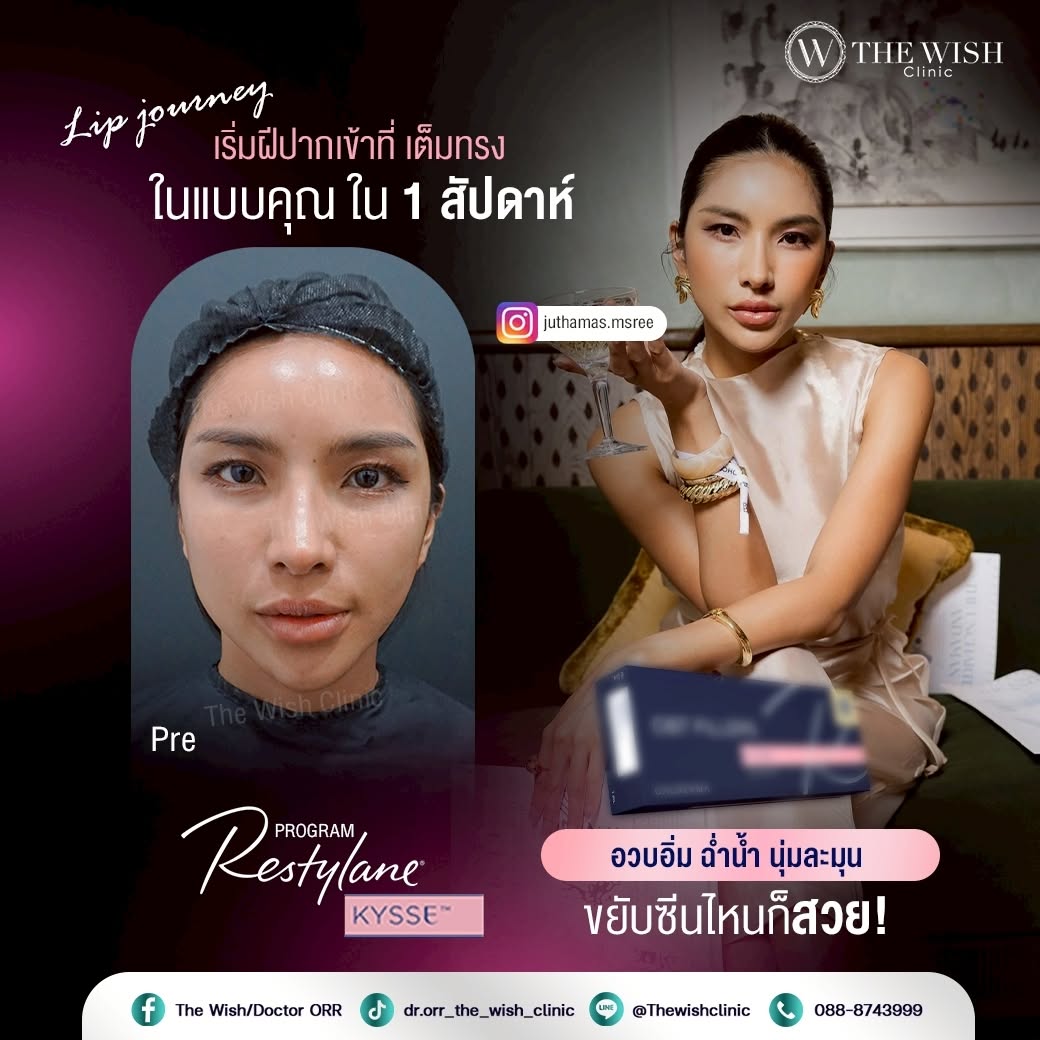 restylane kysse