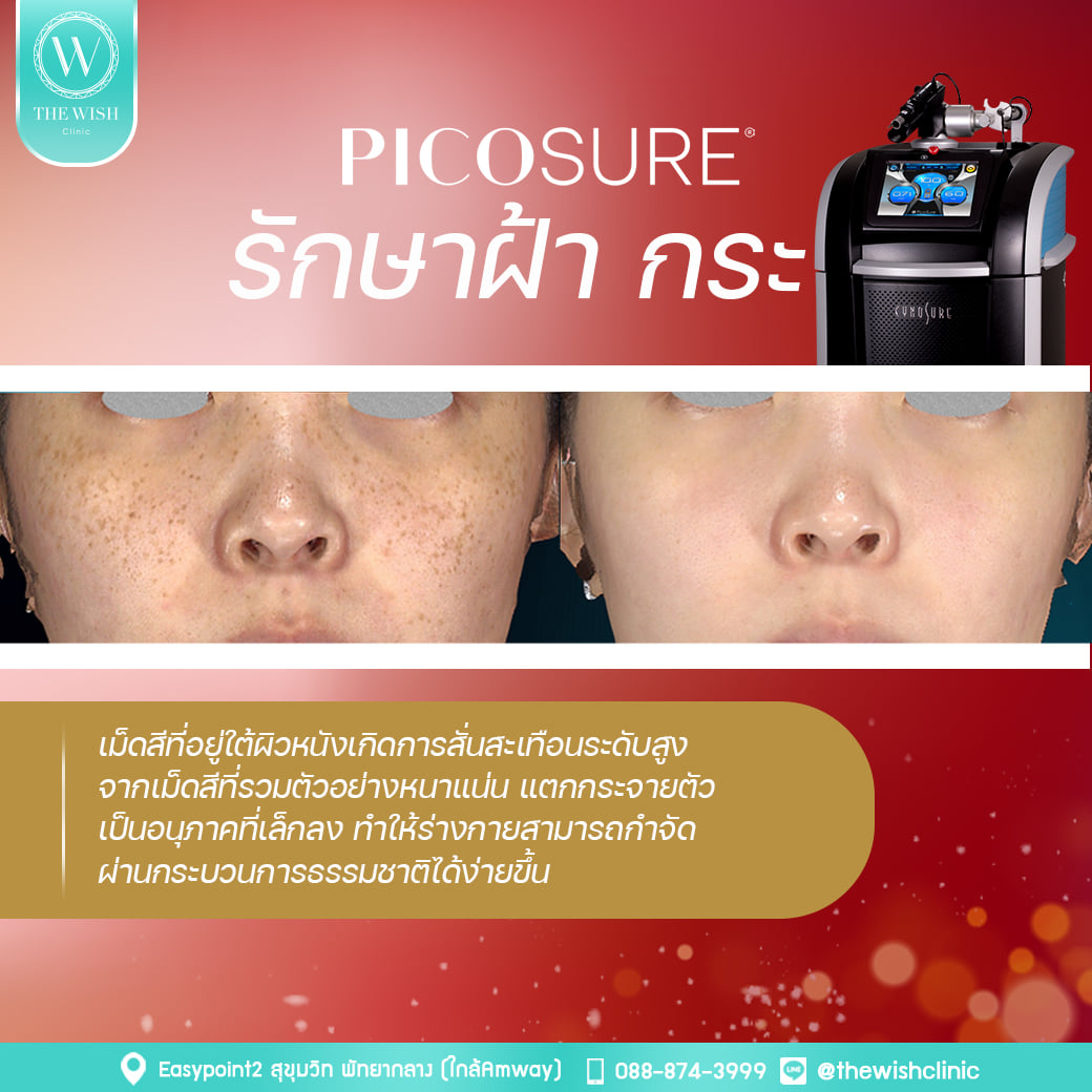 Picosure