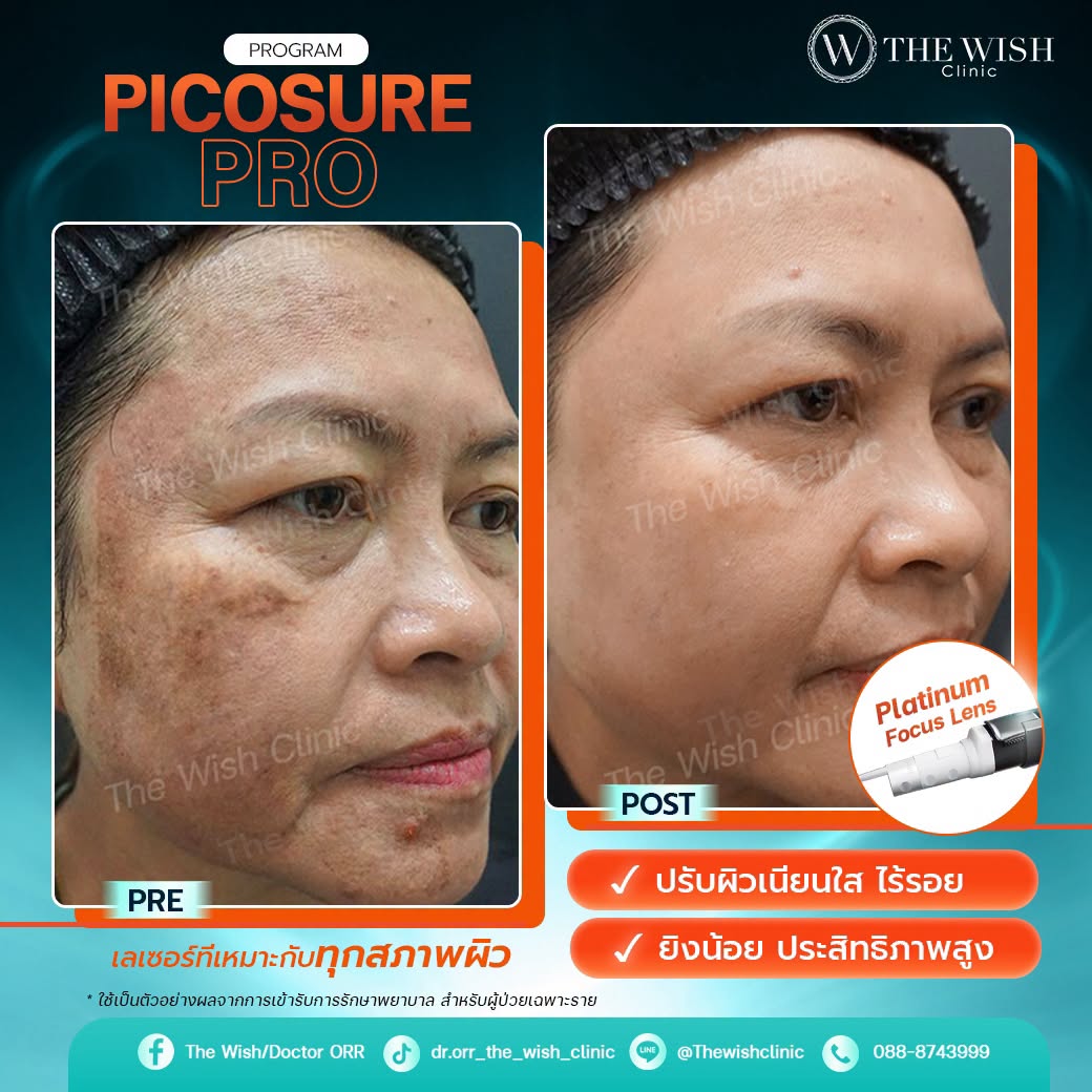 picosure pro