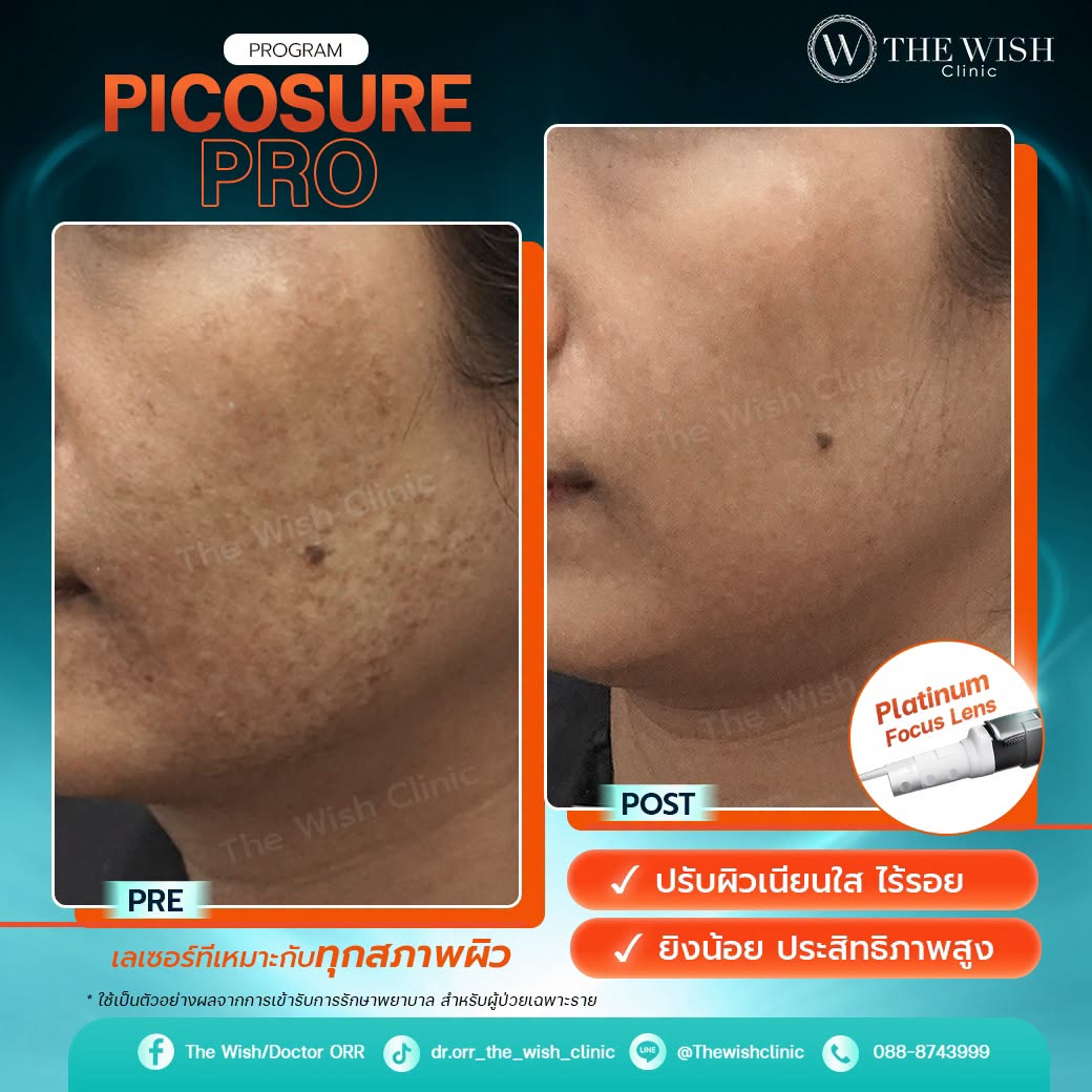 picosure pro