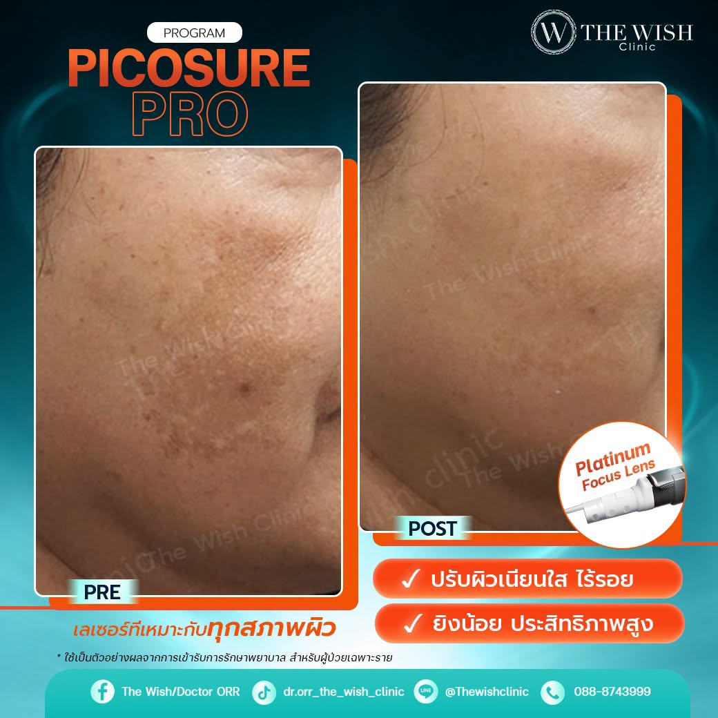 picosure pro