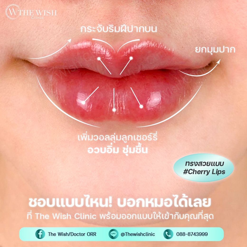 filler lip