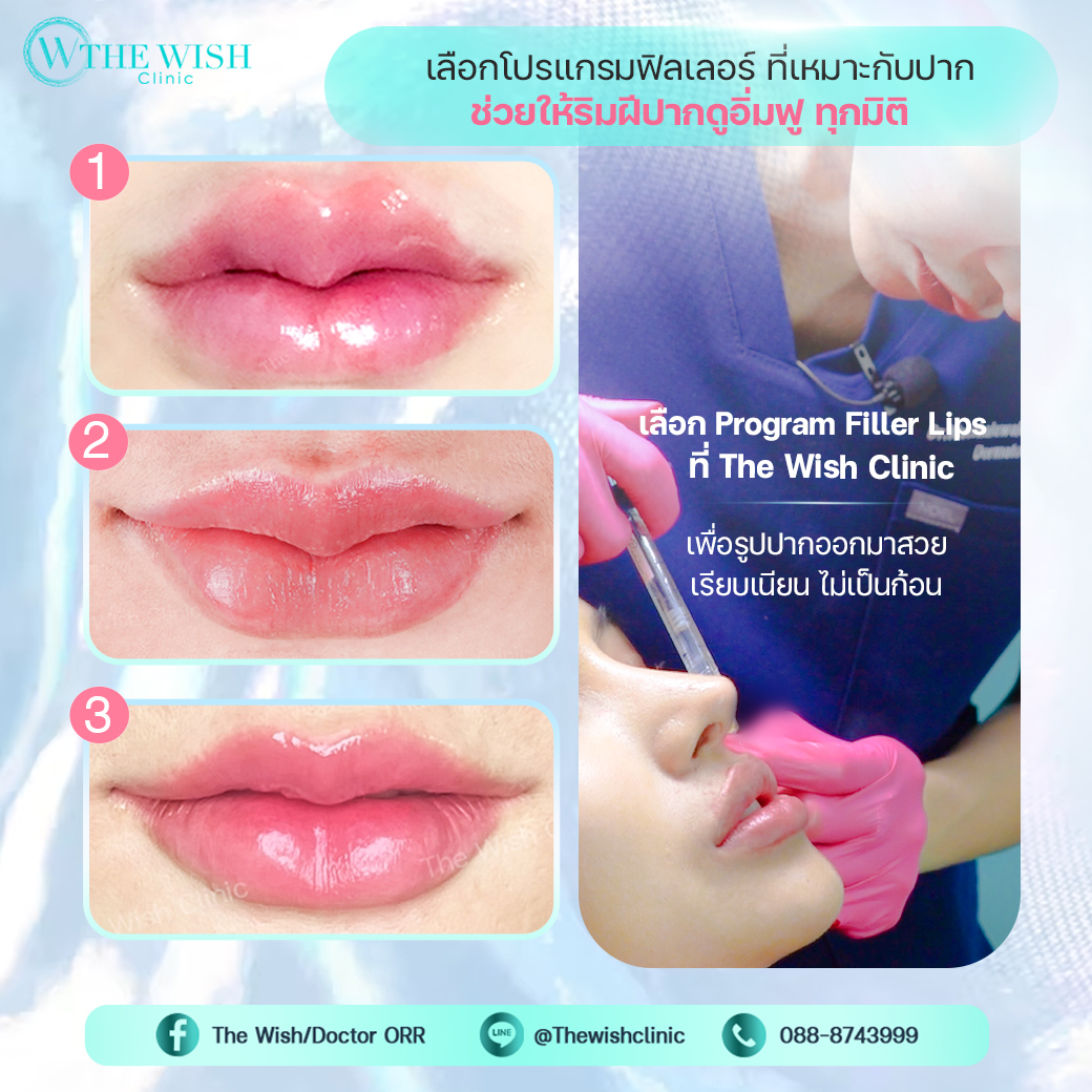 filler lip