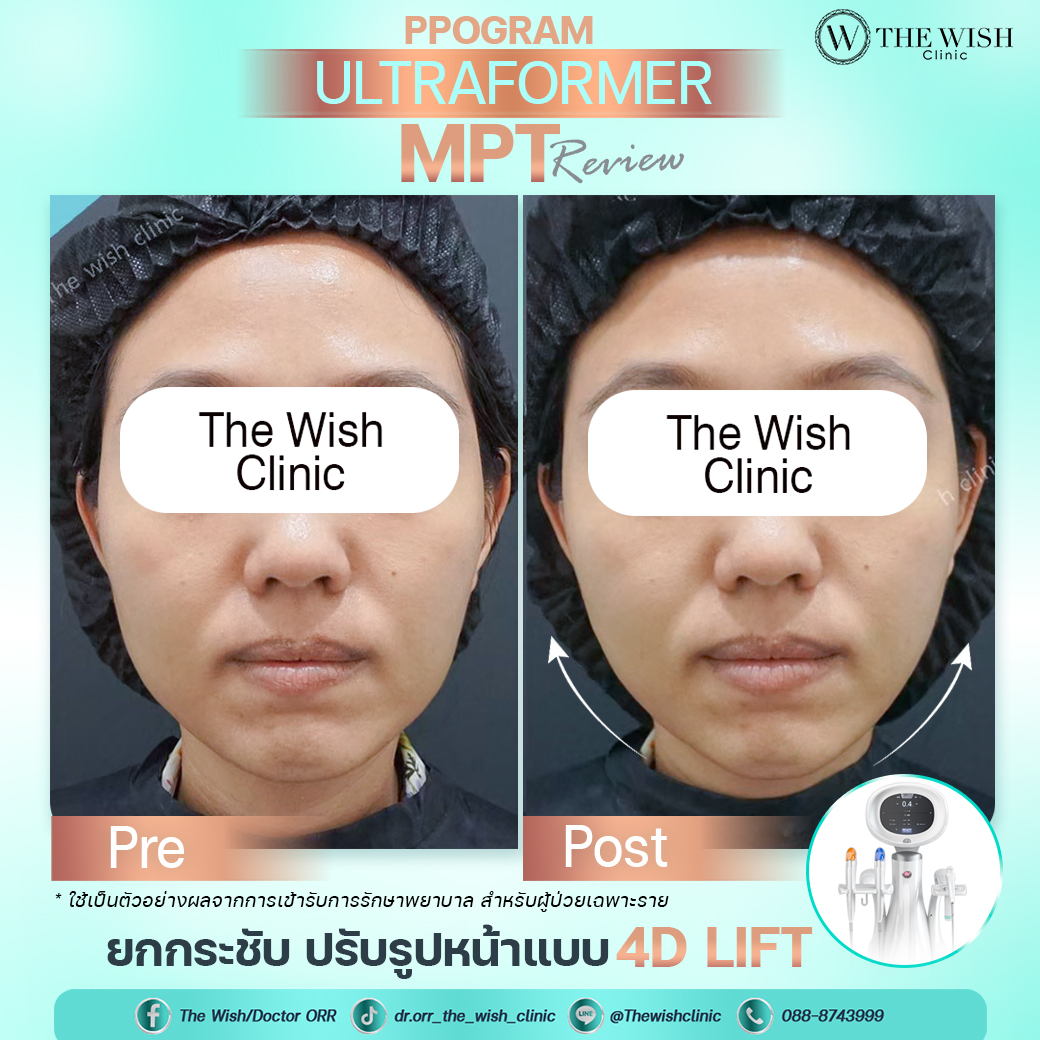 ultraformer mpt