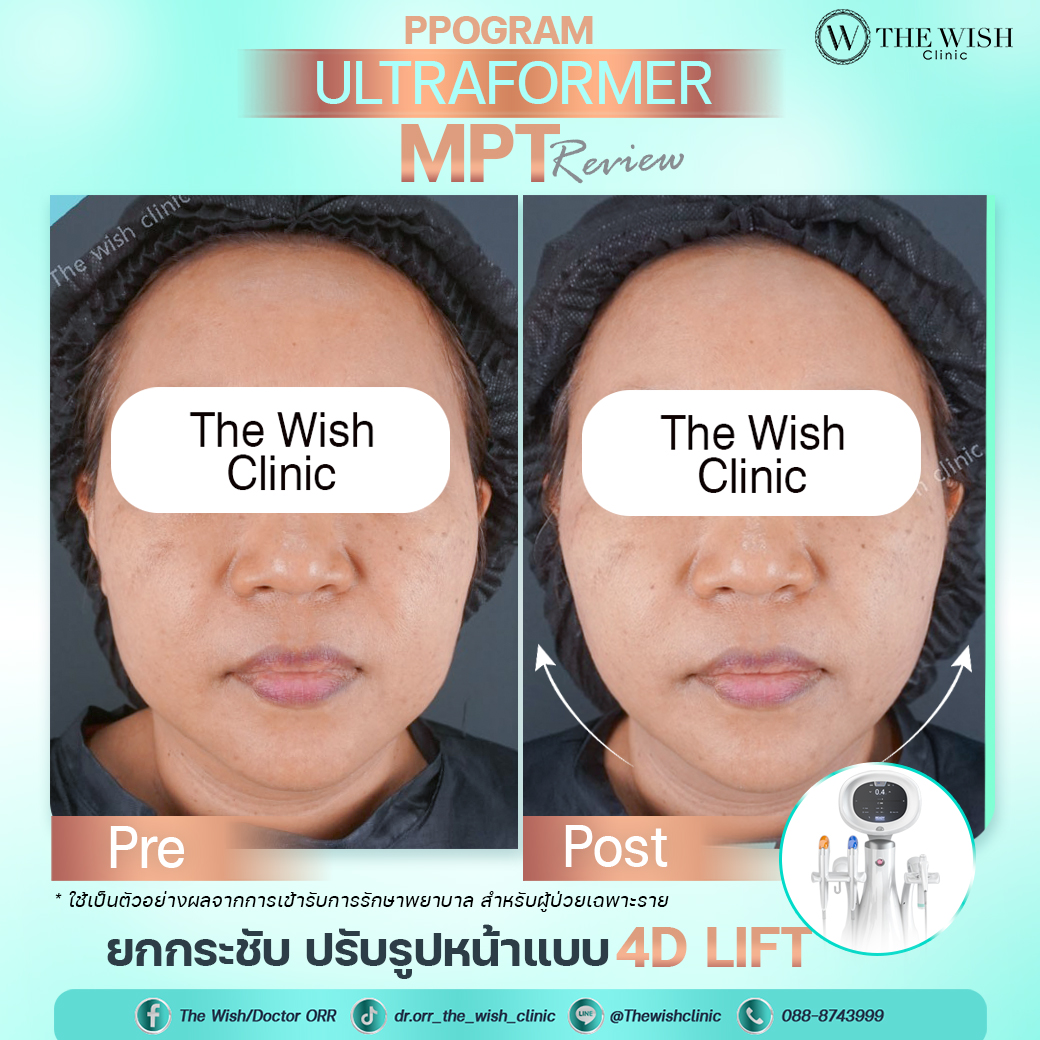 ultraformer mpt
