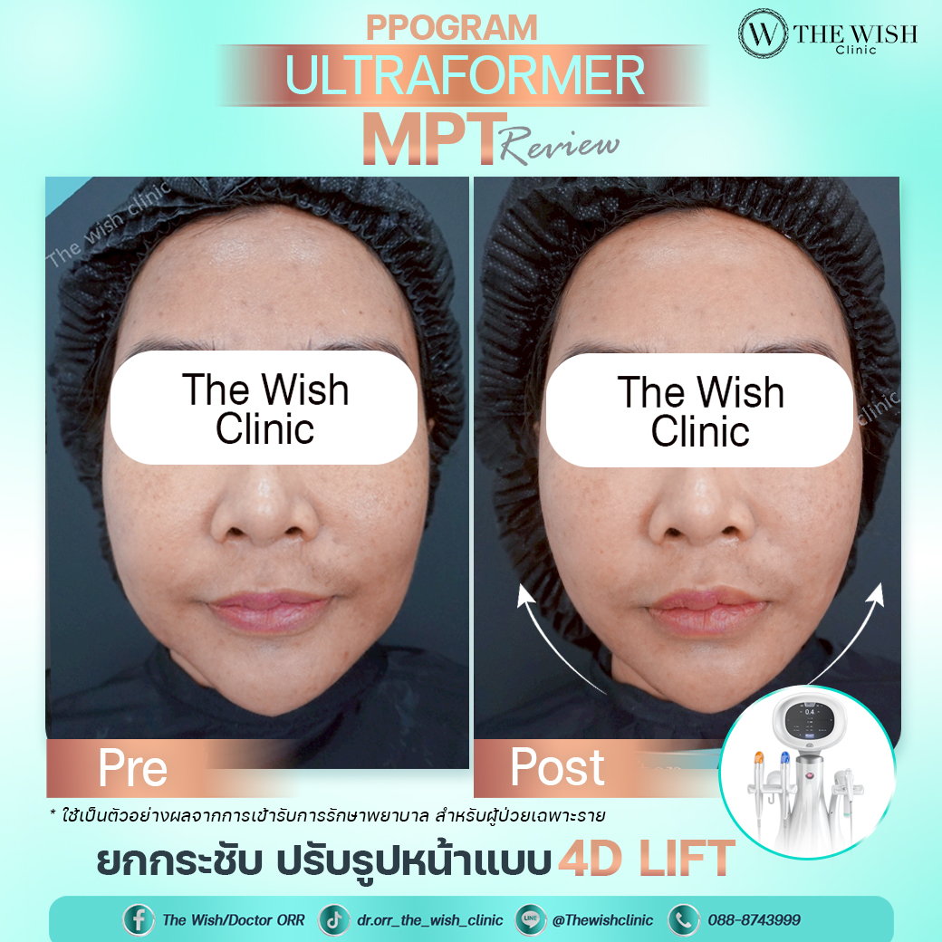ultraformer mpt