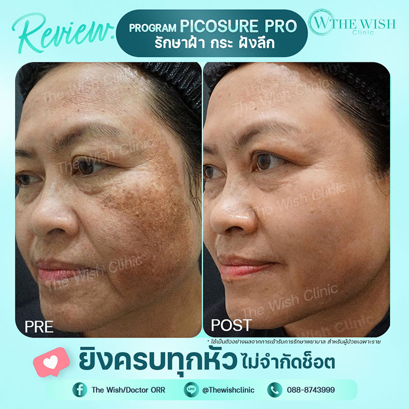 picosure pro