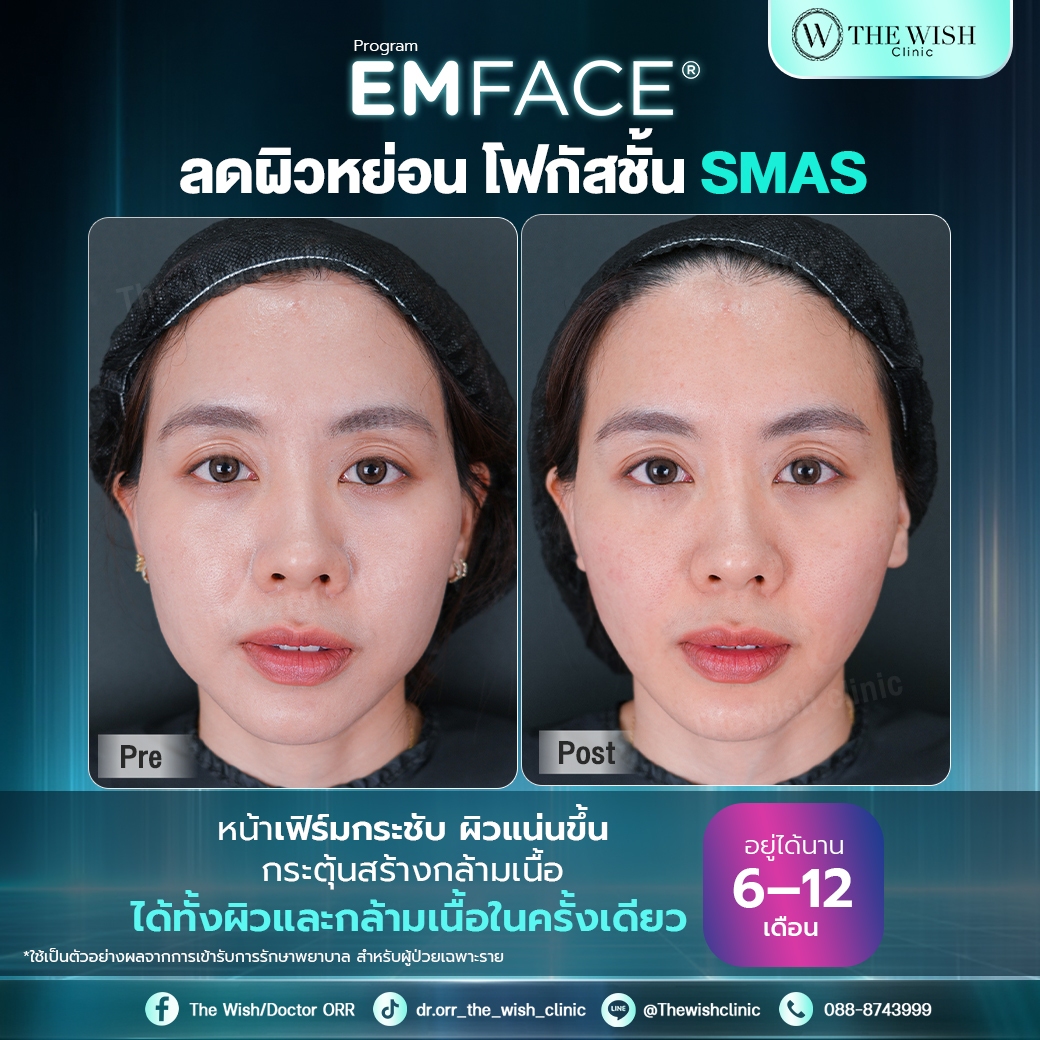 emface