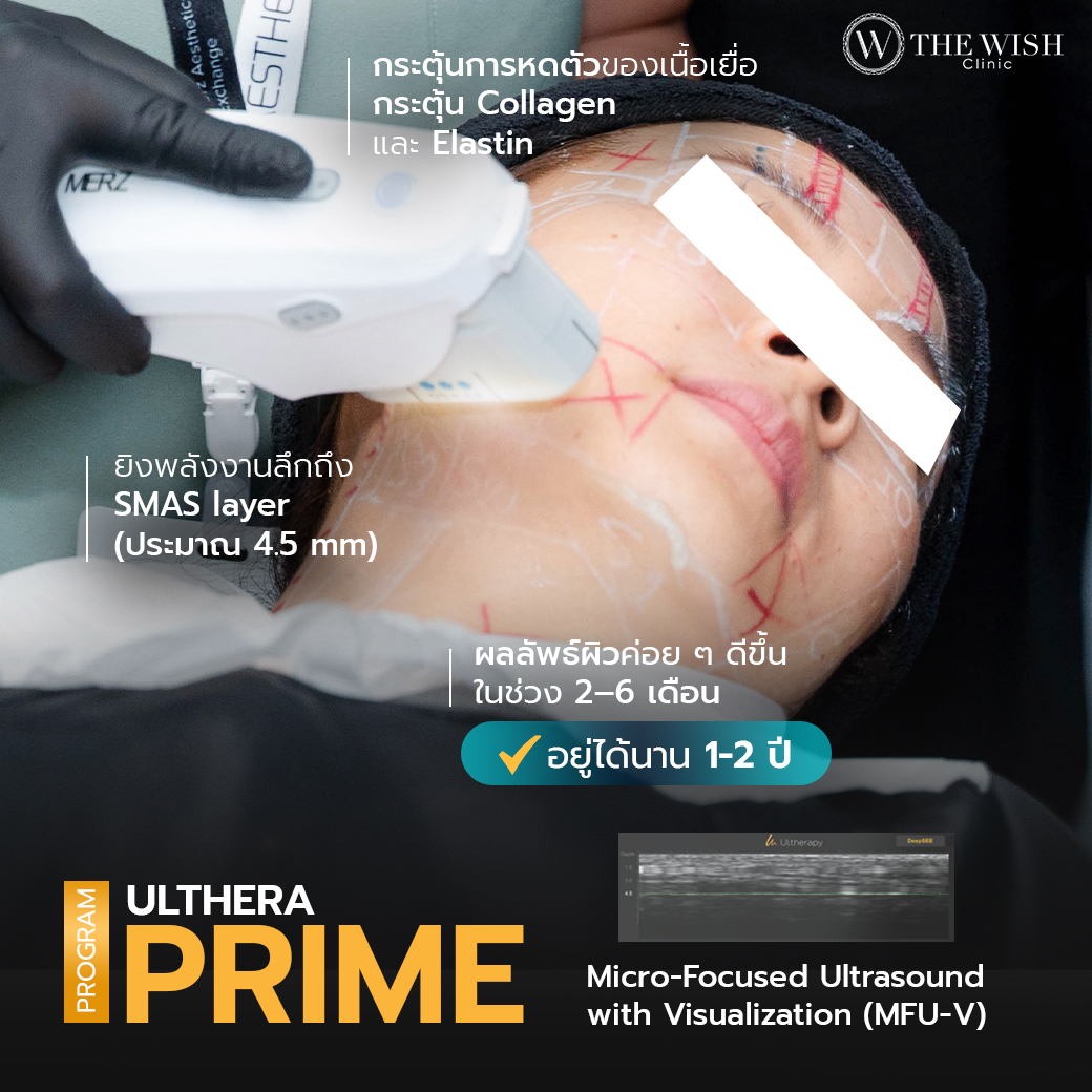ultherapy prime