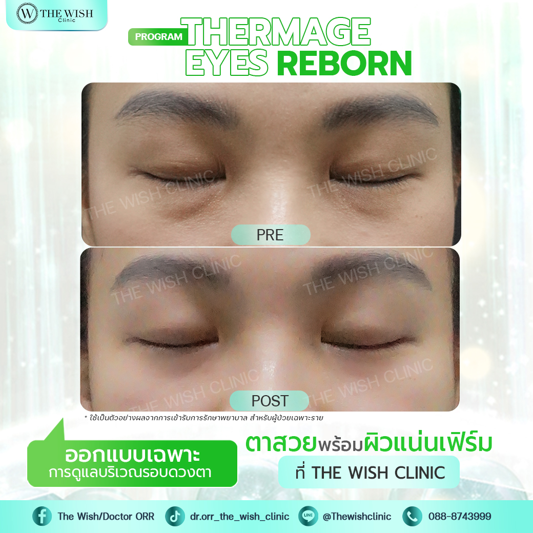 thermage flx