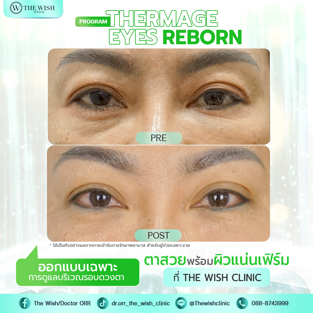 thermage flx