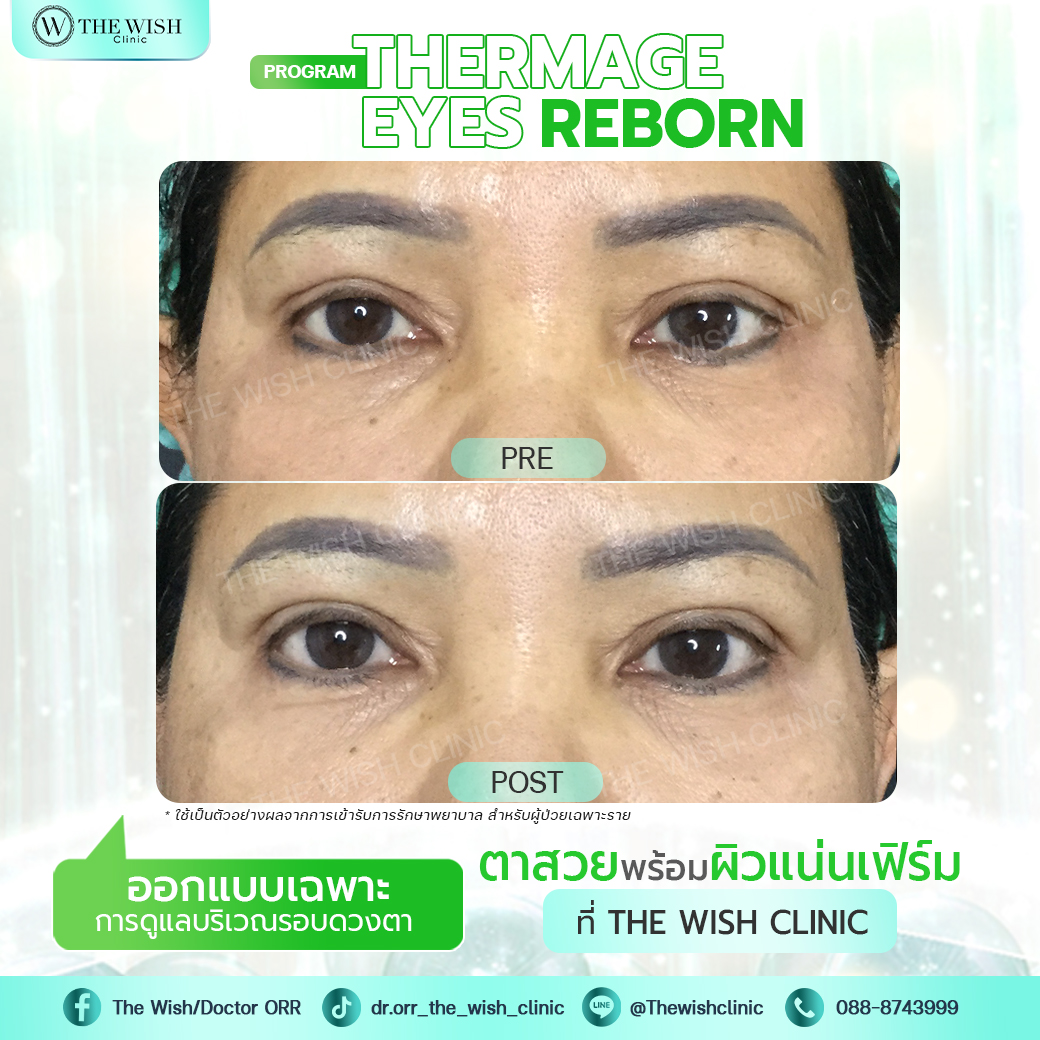thermage flx
