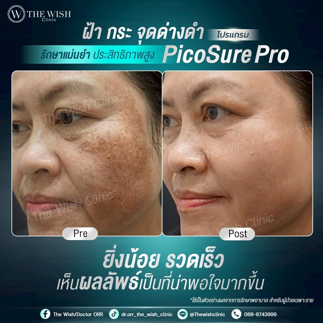 picosure pro