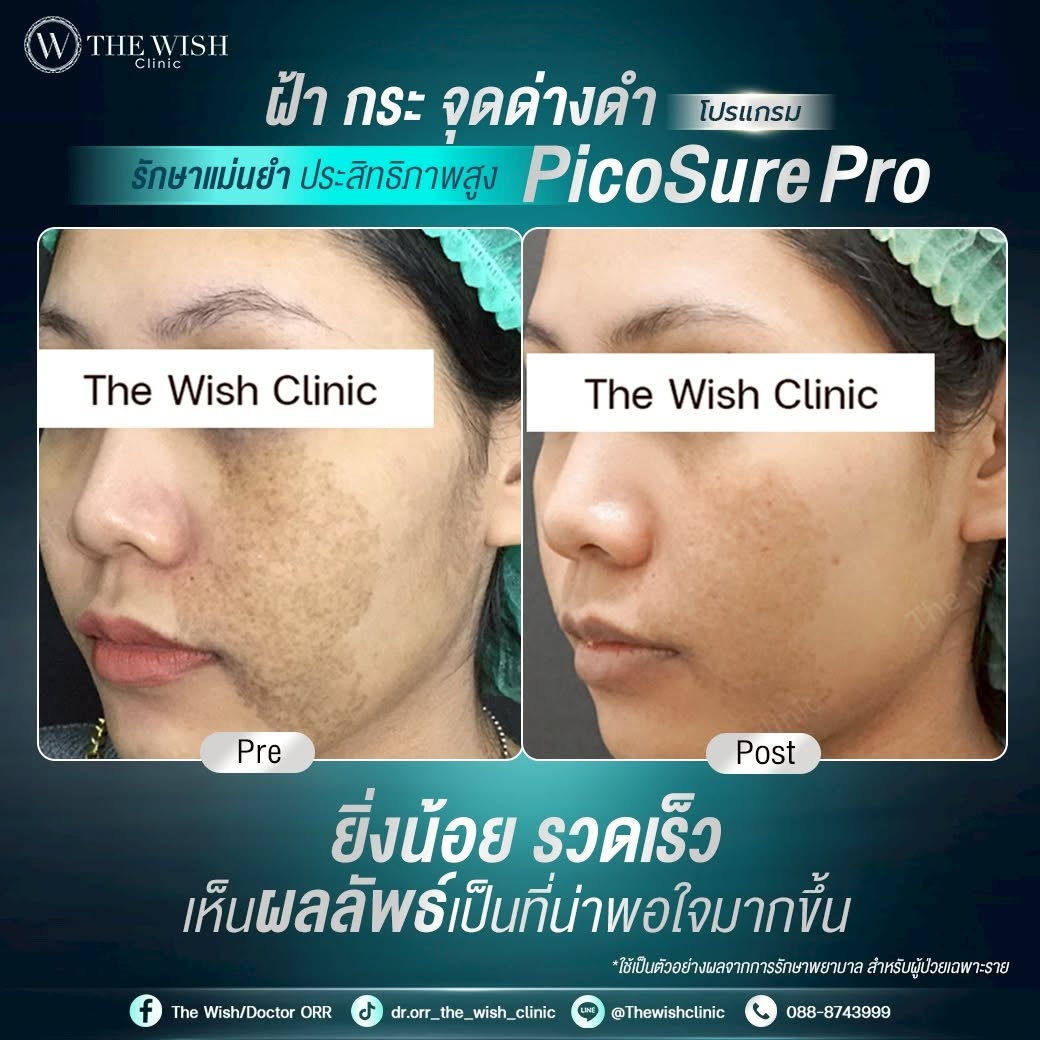 picosure pro