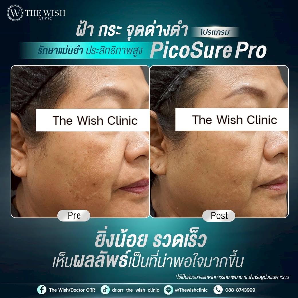picosure pro