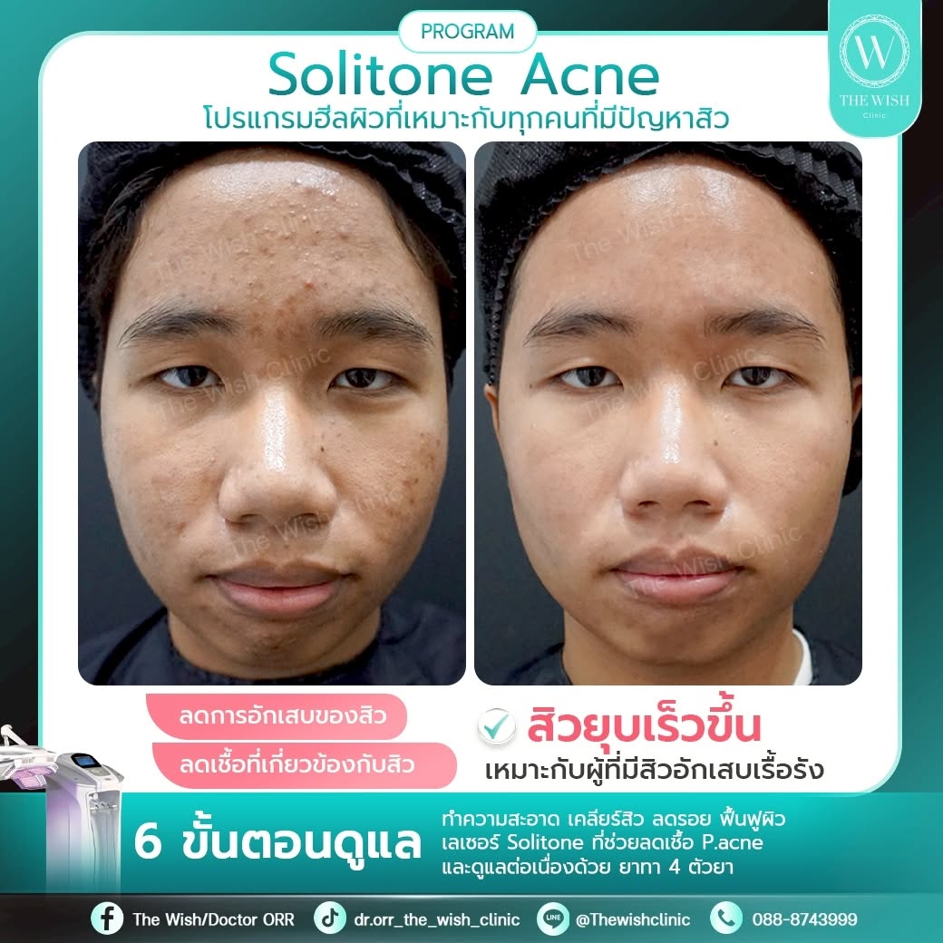 acne