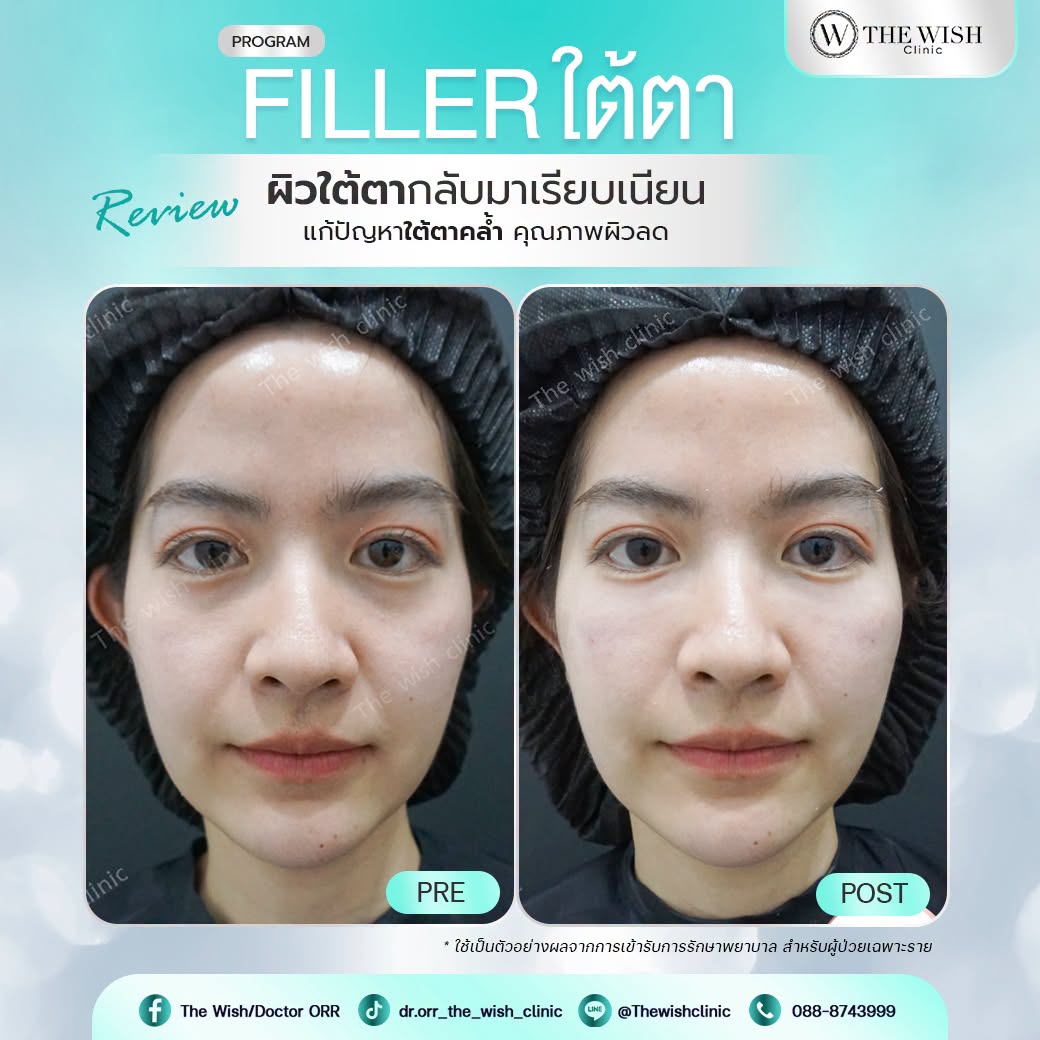 filler
