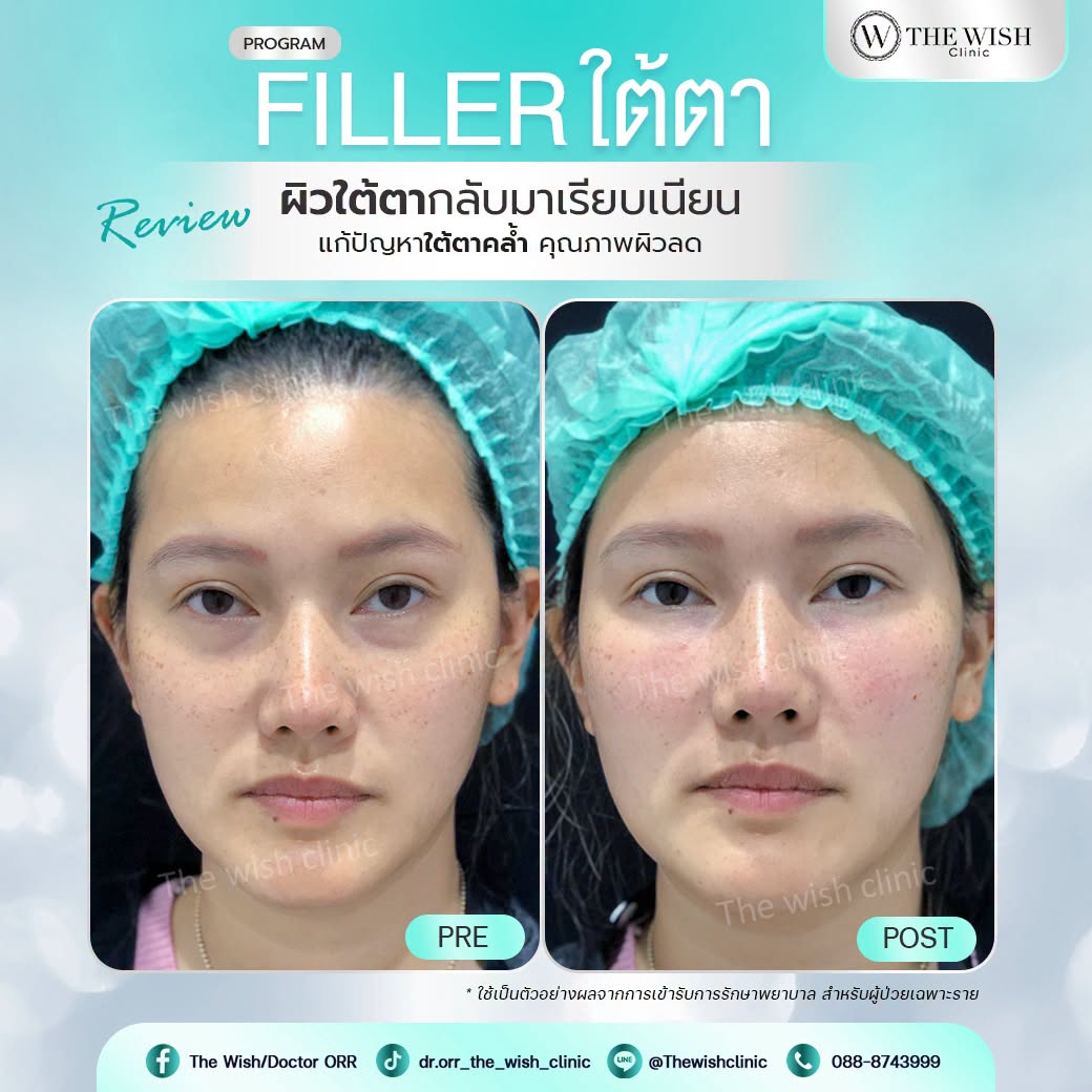 filler