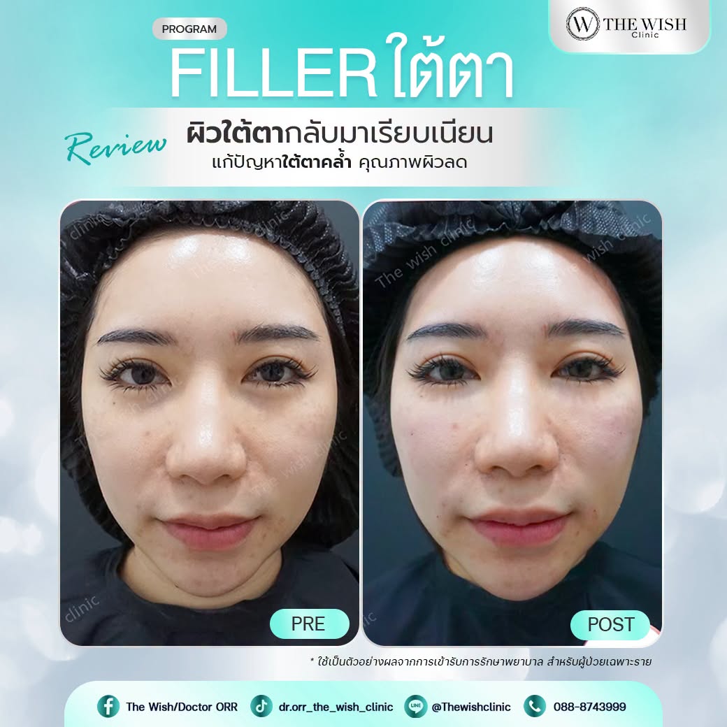 filler