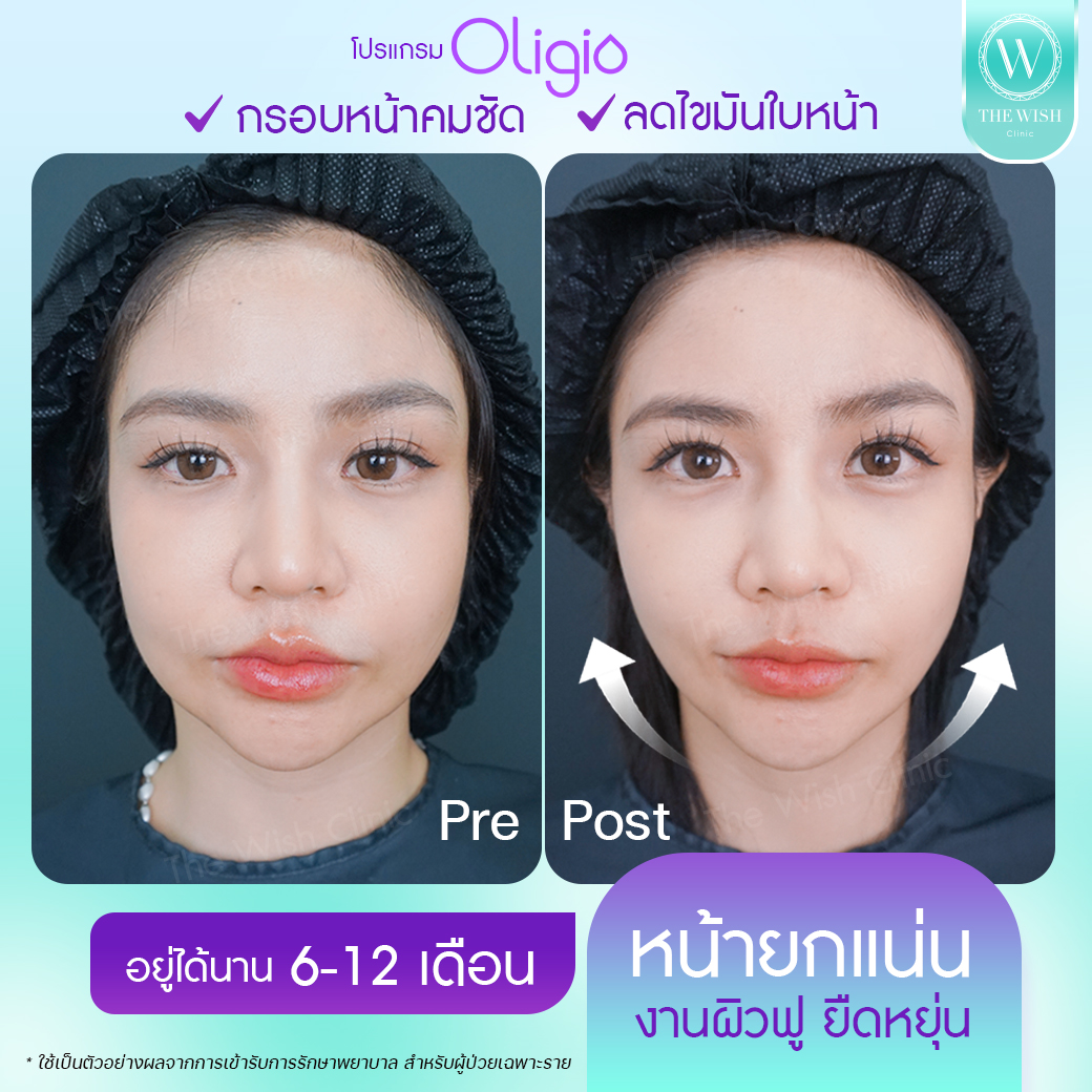 Oligo