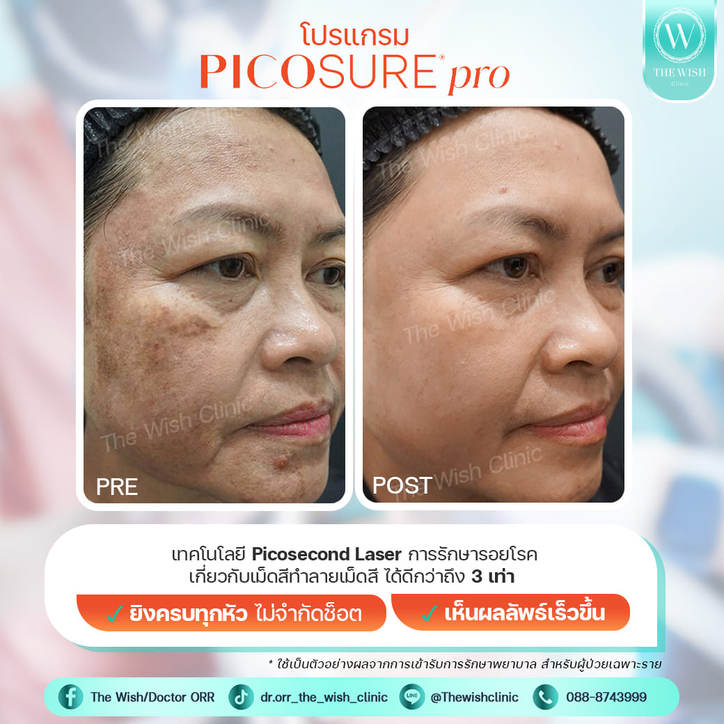 picosure pro