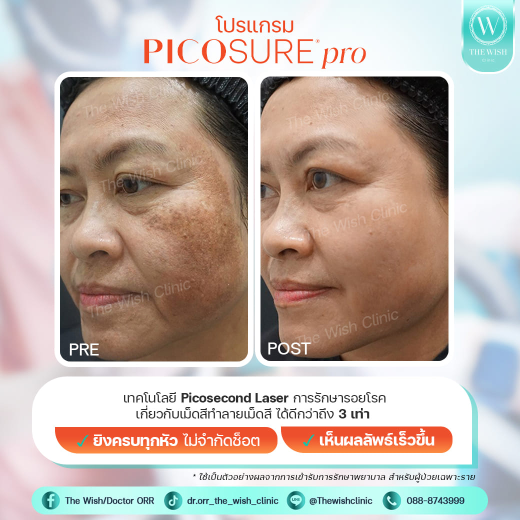 picosure pro