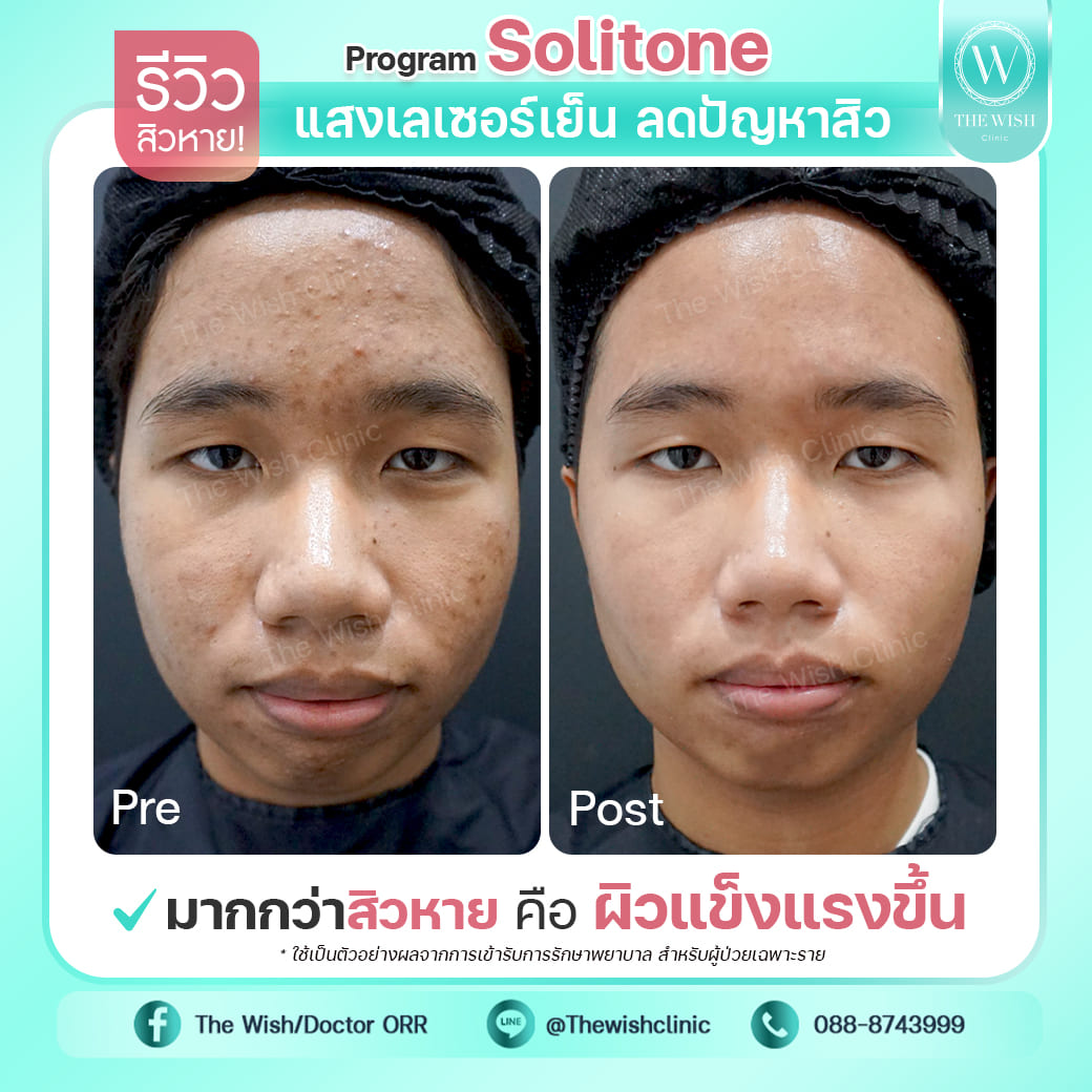 Solitone acne