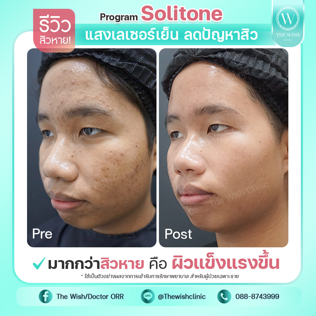 Solitone acne