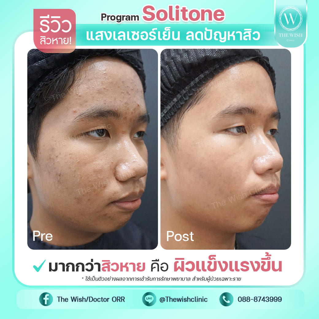 Solitone acne