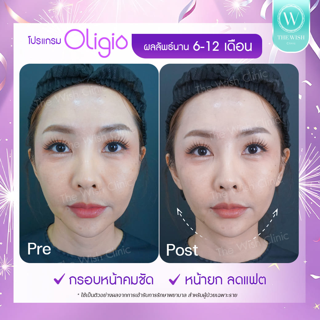 Oligo